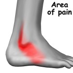 ankle_peroneal_sublux_symptoms