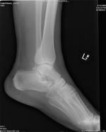 broken ankle side x-ray